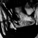 Shirley, a domestic worker in Hong Kong, suffered 3rd degree burns while she was working.